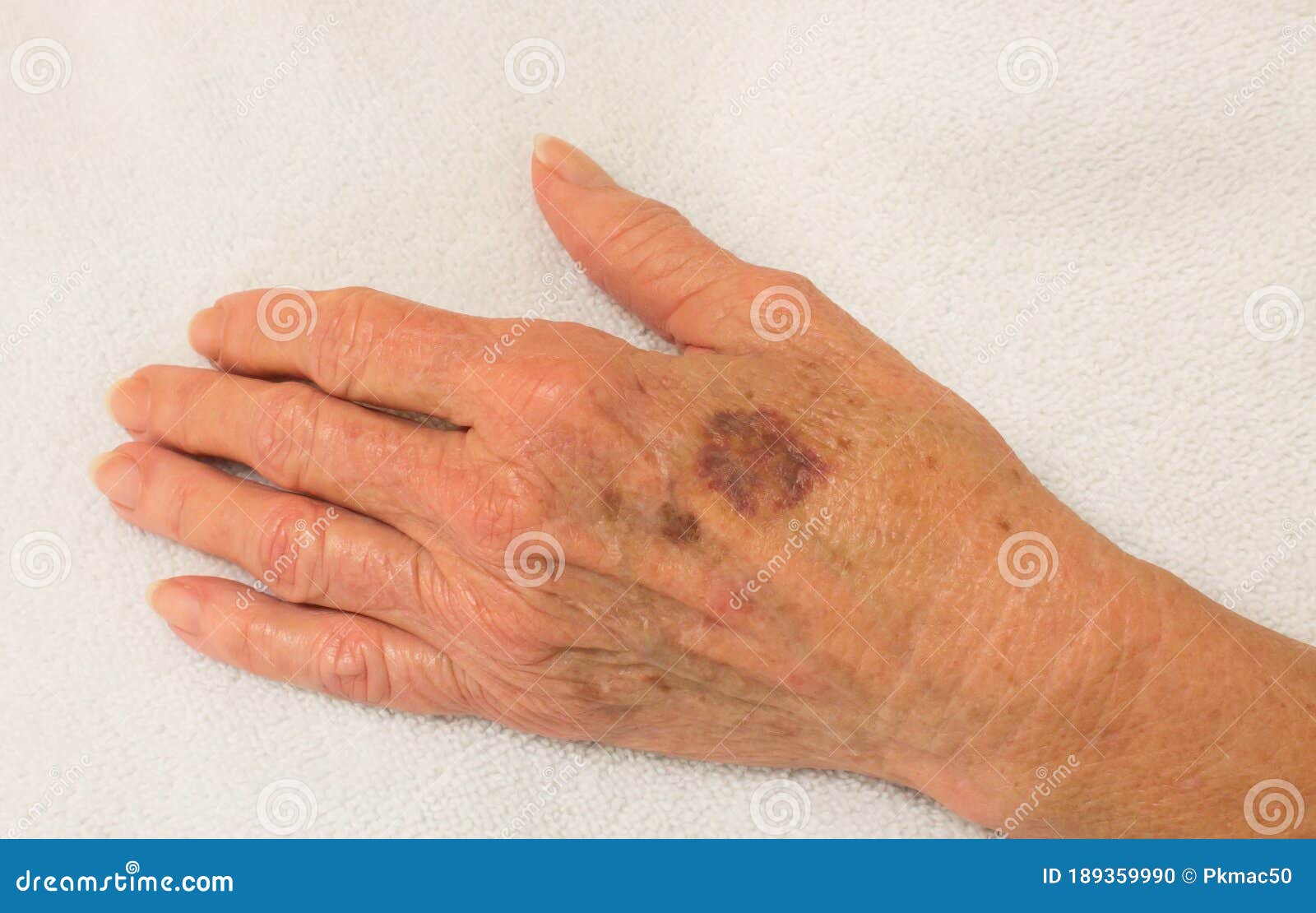 Red Bruises On Elderly Skin - Blauwe Handen En Voeten Bij Ouderen