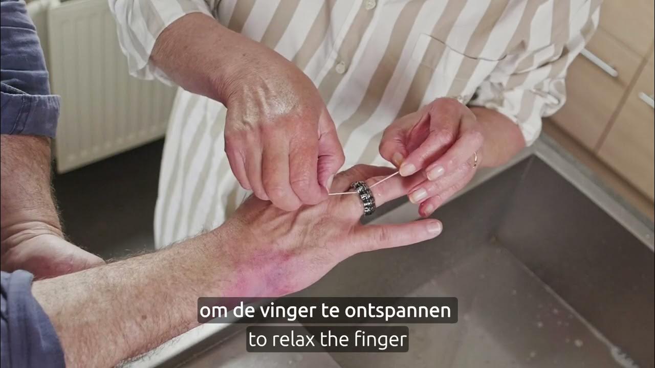 Ring verwijderen - YouTube - Jodium Verwijderen Van Huid Na Operatie
