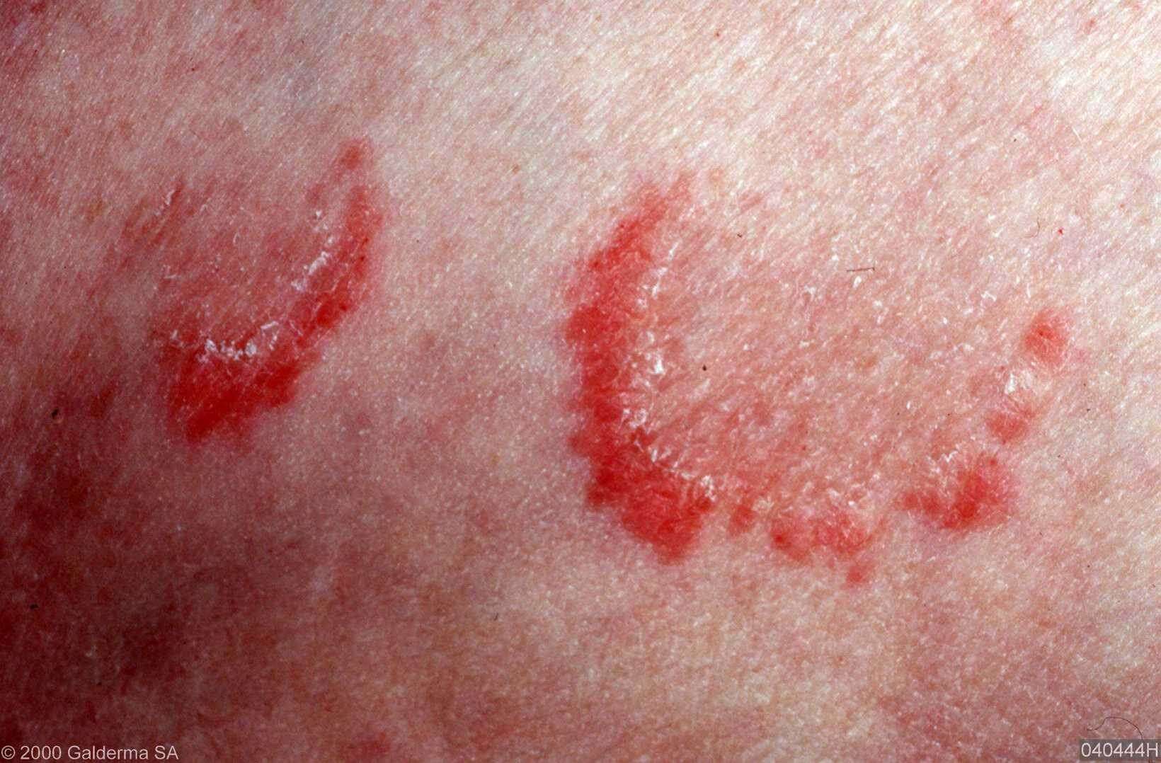 ringworm huid - DrBeckmann - Bruine Vlekken Op Huid Schimmel