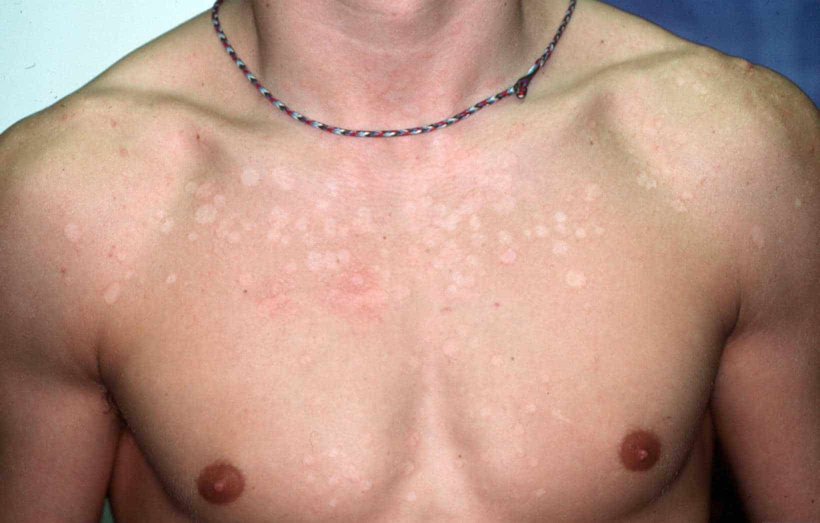 ringworm huid - DrBeckmann - Bruine Vlekken Op Huid Schimmel