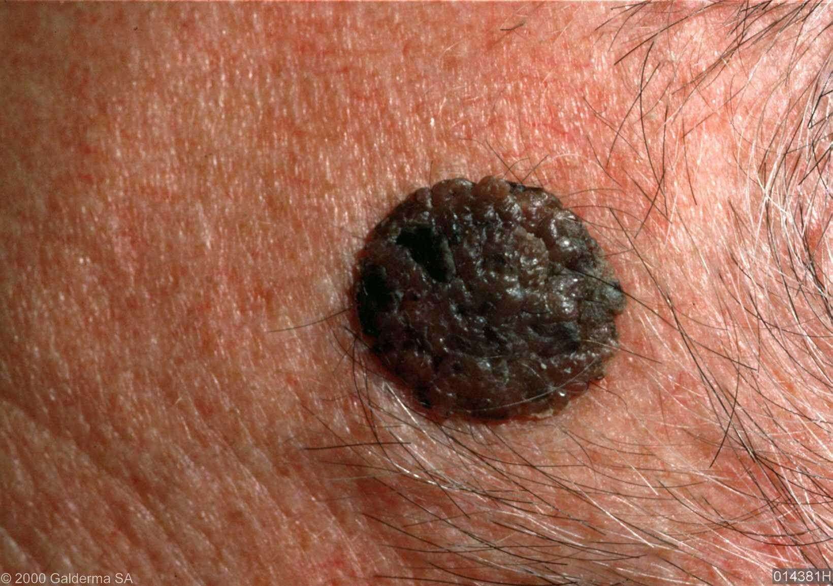 ringworm huid - DrBeckmann - Zilver Wordt Zwart Op De Huid