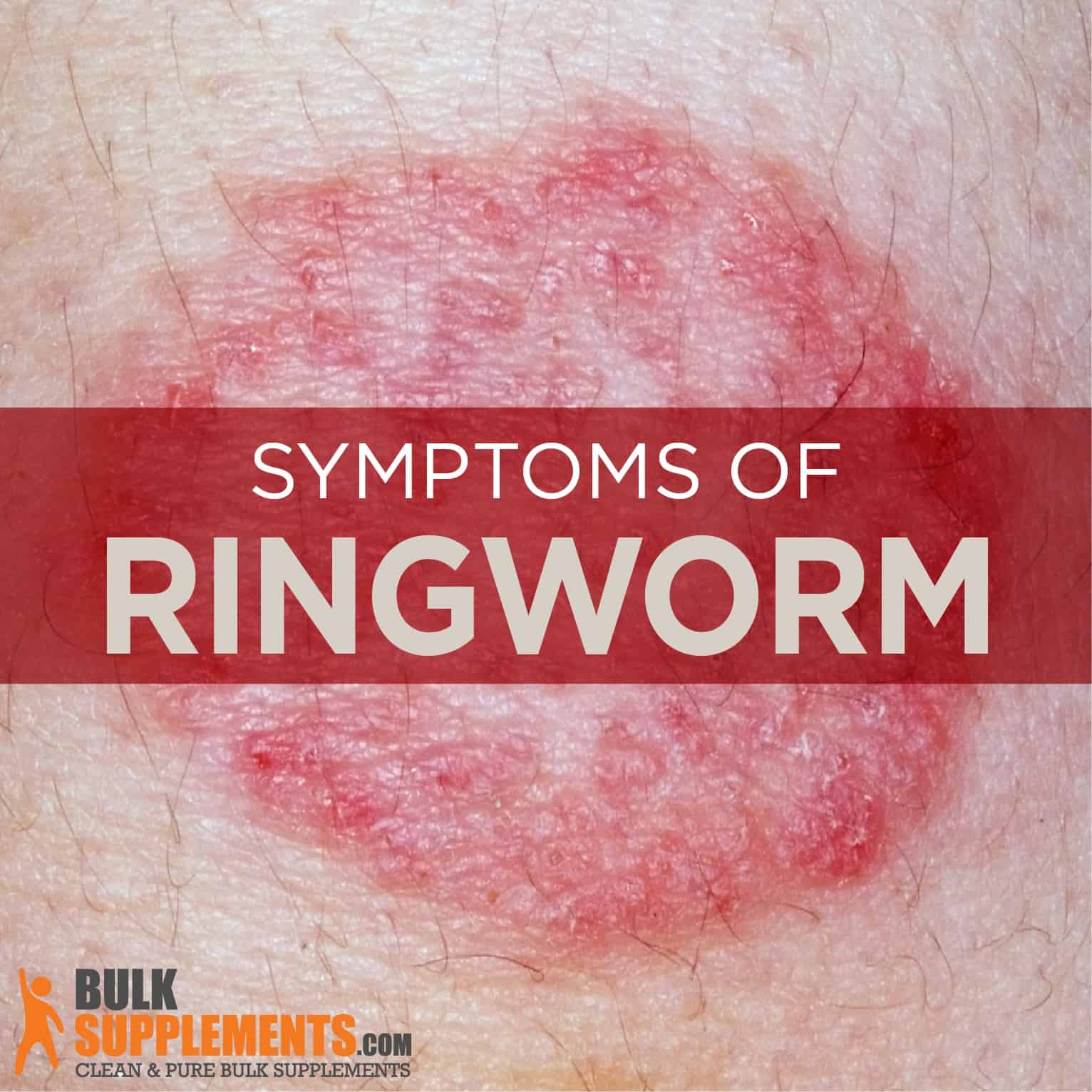 Ringworm Rode Kring Op Huid