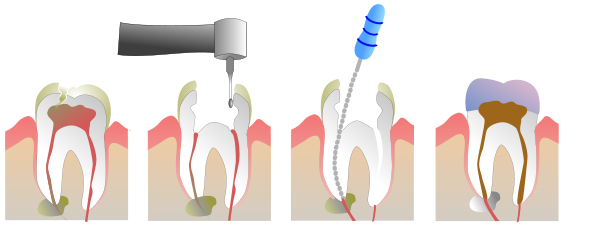 Root canal - Wikipedia - Hoeveel Wortelkanalen Heeft Een Kies