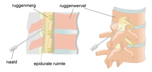 Rugpijn door een ingezakte wervel | Pijnbehandelcentrum - Pijn In Rug Met Hoesten