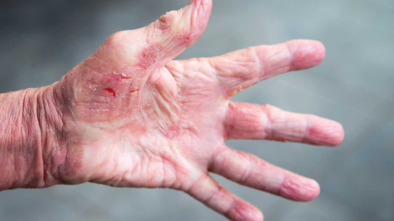 Scabies Rash Neck - Wat Te Doen Aan Schaafwond
