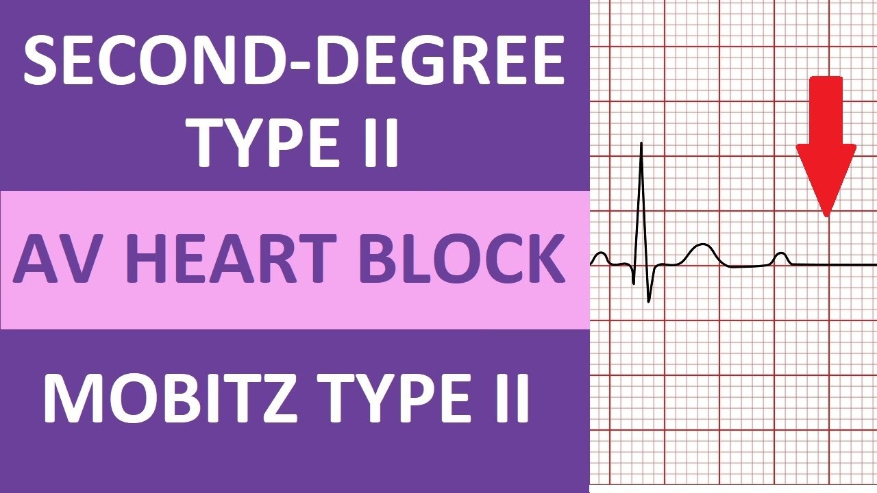 Second-Degree Type 2 Heart Block ECG Rhythm Nursing NCLEX | Mobitz Type - 2e Graads Av Blok Behandeling