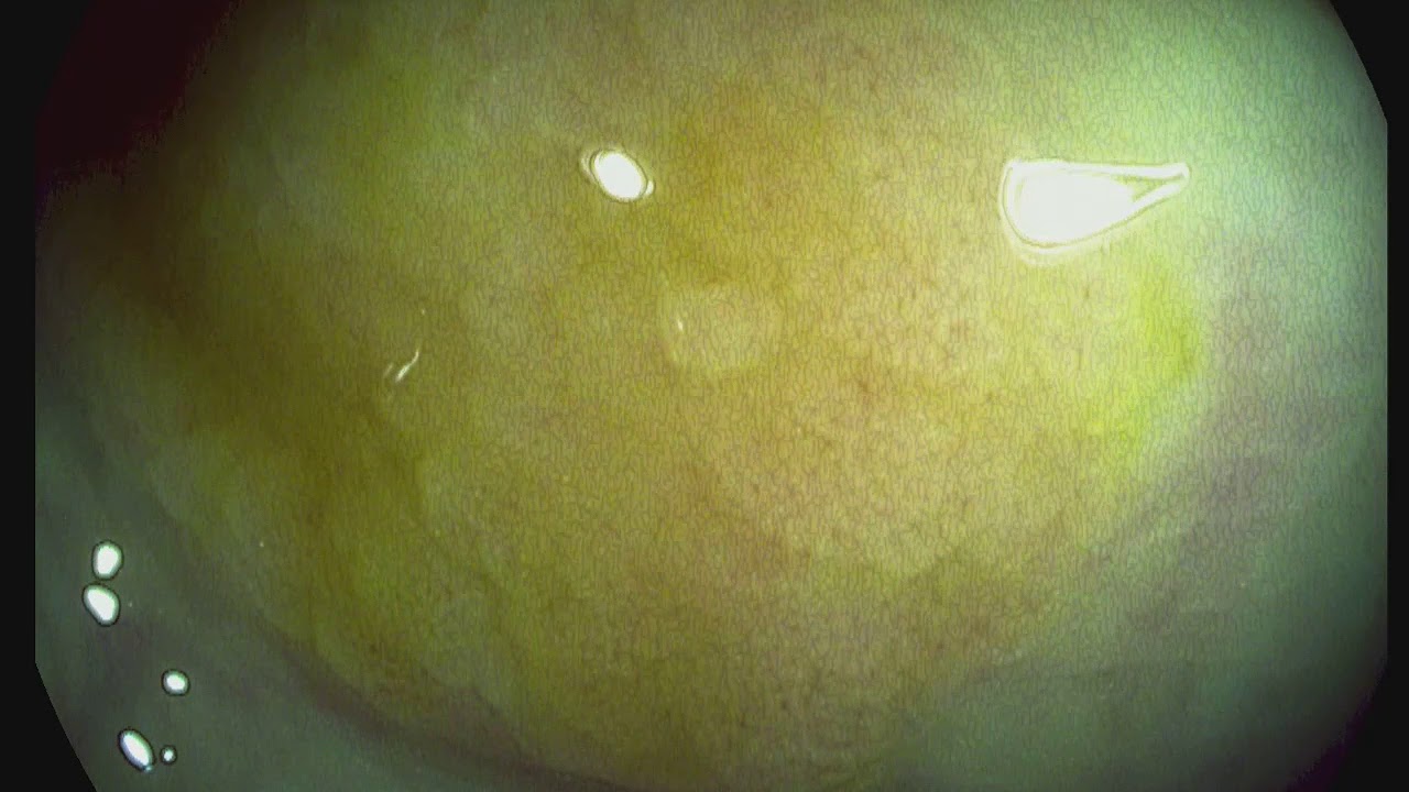Sessile serrated adenoma - YouTube - Sessiel Serrated Laesie Zonder Dysplasie