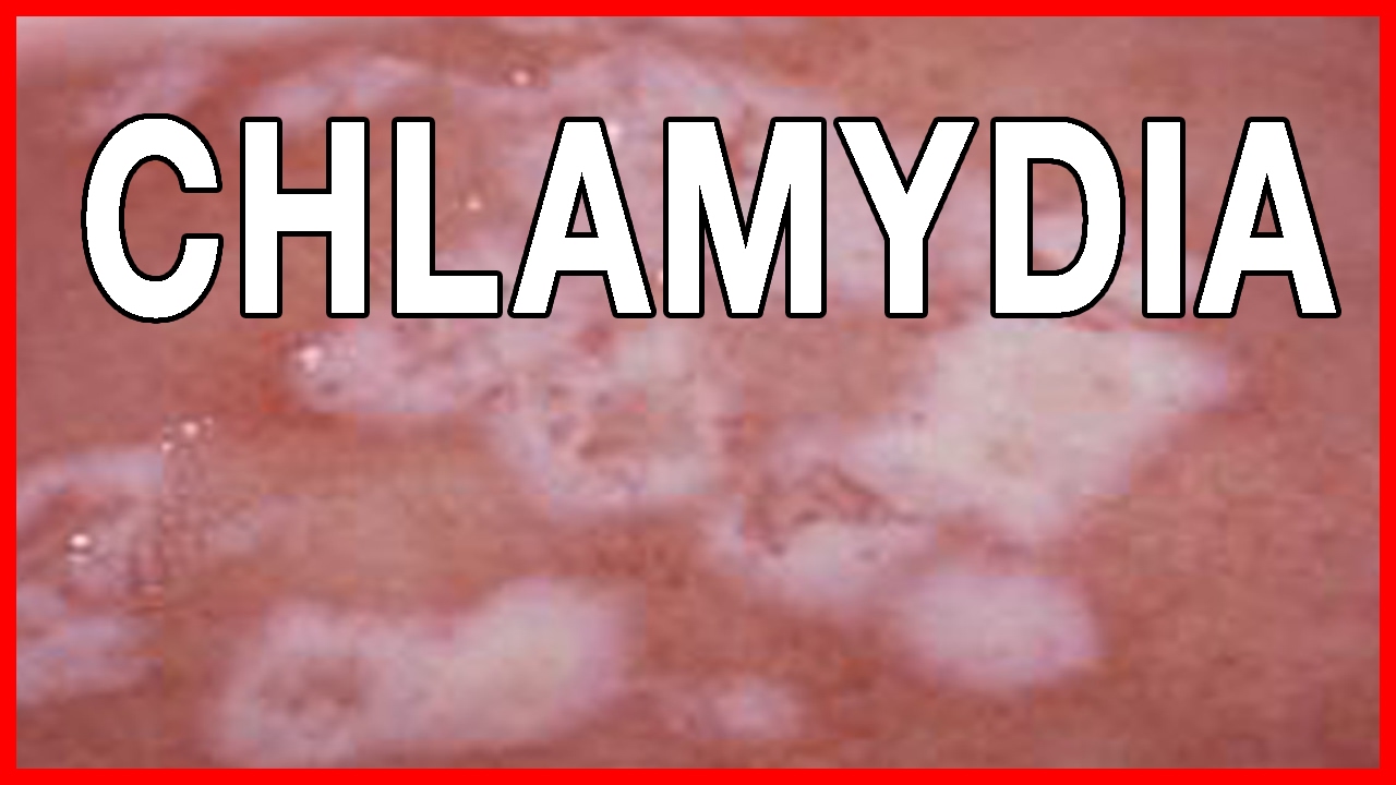 Signs and Symptoms of Chlamydia // How to Treat Chlamydia in Women and - Wat Te Doen Bij Chlamydia