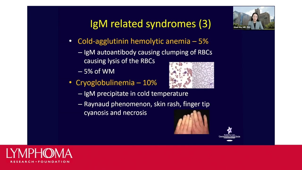 Simple Headache Revealed A Rare Lymphoma: Waldenstrom, 46% OFF - Ziekte Van Waldenstrom In Het Laatste Stadium