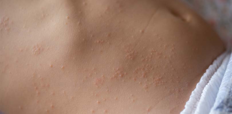 Sixth Disease: Causes, Symptoms and Treatment Options - Wat Is De 6e Ziekte