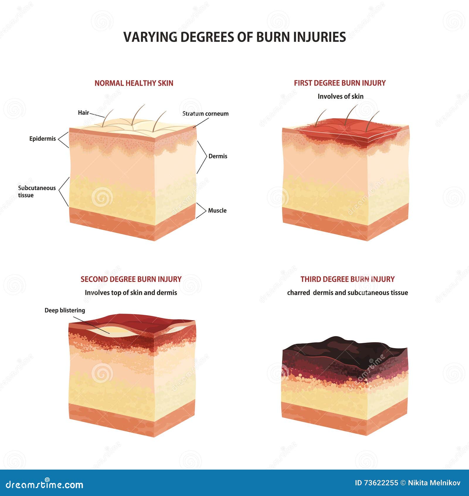 Skin Burn Classification. Cartoon Vector | CartoonDealer.com #73622255 - Brandwonden 1e 2e 3e Graads