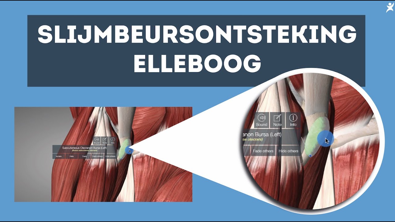 Slijmbeursontsteking elleboog? Ontdek de oplossing! - YouTube - Ineens Blauwe Plek Onder Voet