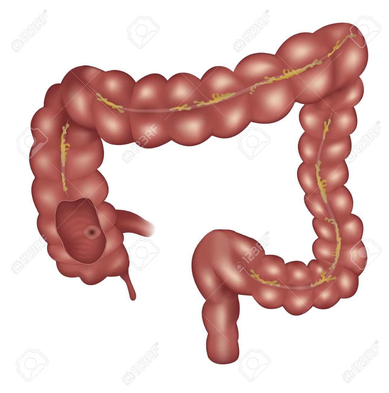 Small Intestine Clipart | Free download on ClipArtMag - Ontsteking Van De Dikke Darm