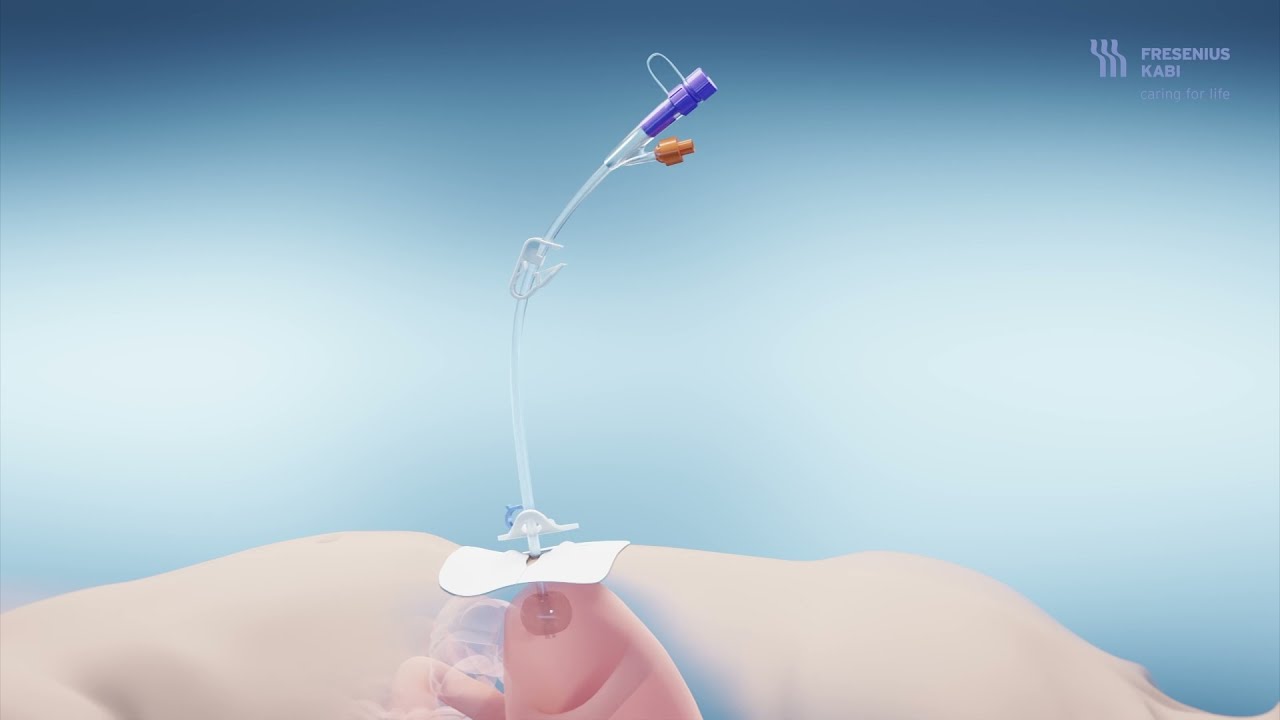 Sondenanlage der perkutanen Austauschsonde Freka® Pexact in der - Verschil Peg Sonde En Mickey Button