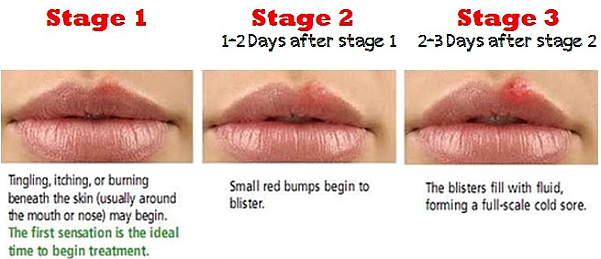 sore on lip pictures - pictures, photos - Wanneer Koortslip Niet Meer Besmettelijk