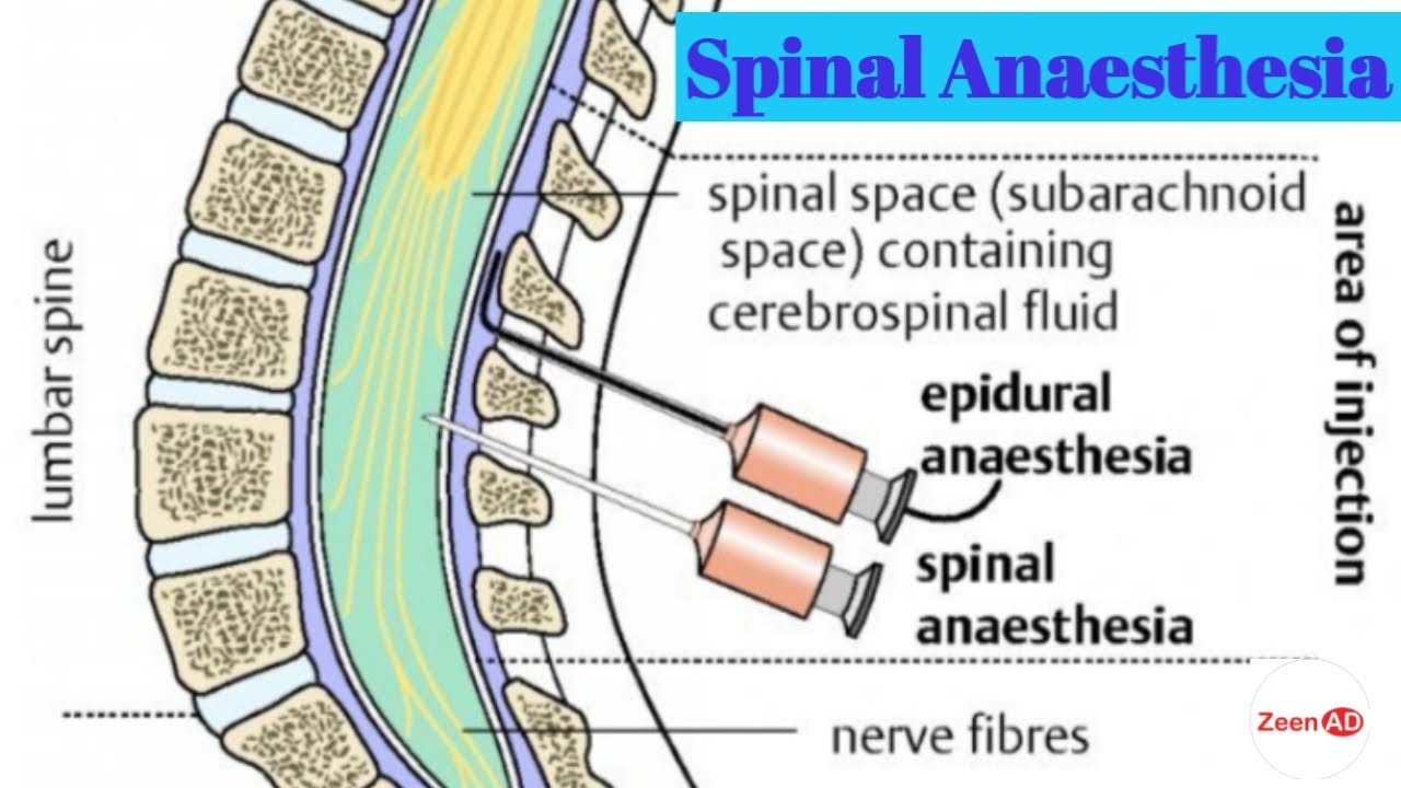 Spinal And Epidural Anesthesia Indications Advantages Disadvantages - Ruggenprik Of Narcose Bij Heupoperatie