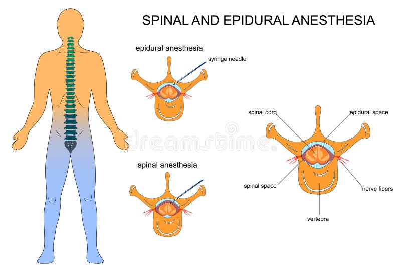 Spinal injury icon Free Stock Photos - StockFreeImages - Verschil Spinale En Epidurale Anesthesie