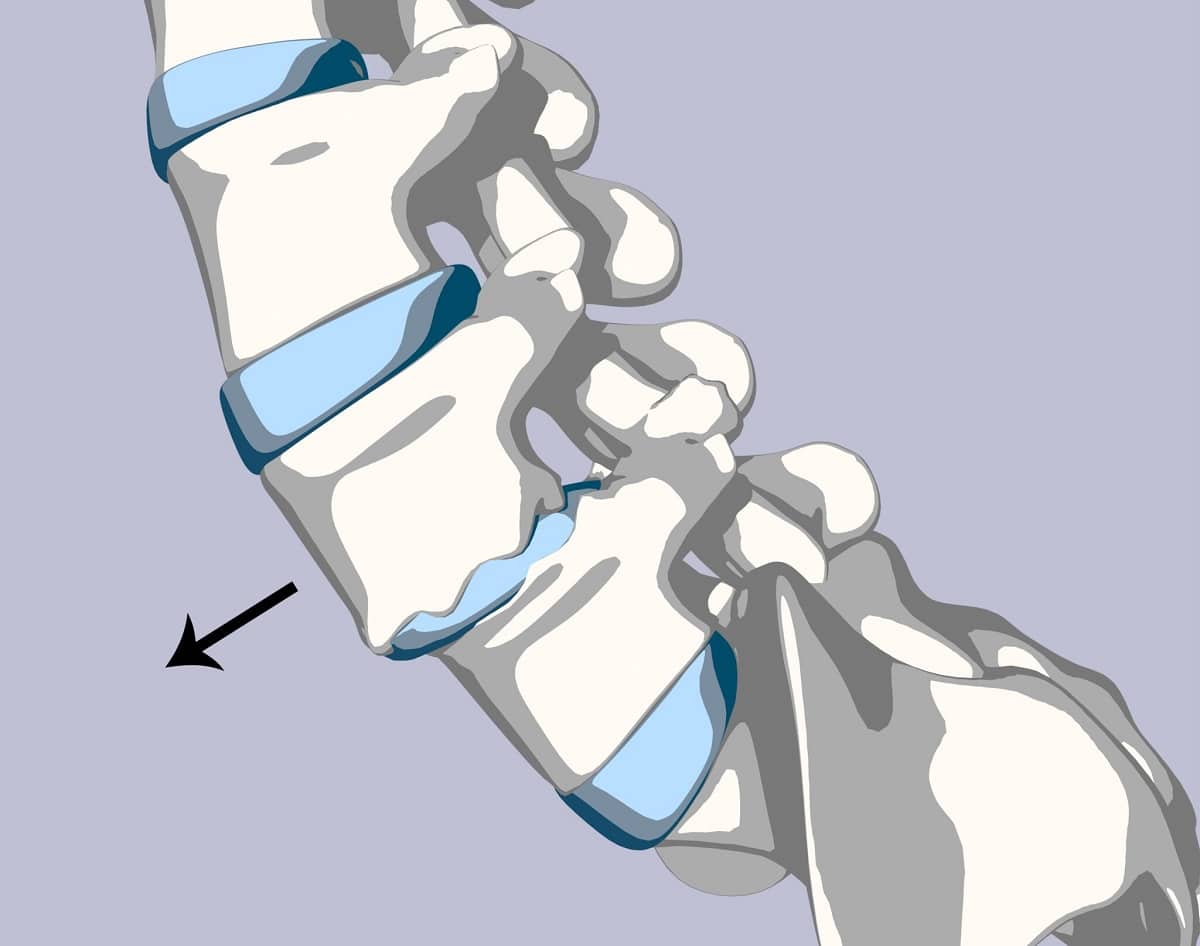 Spondylosis: Definition, Causes, Symptoms, Diagnosis, and Treatment - Hoe Groot Is Oekraïne Ten Opzichte Van Nederland