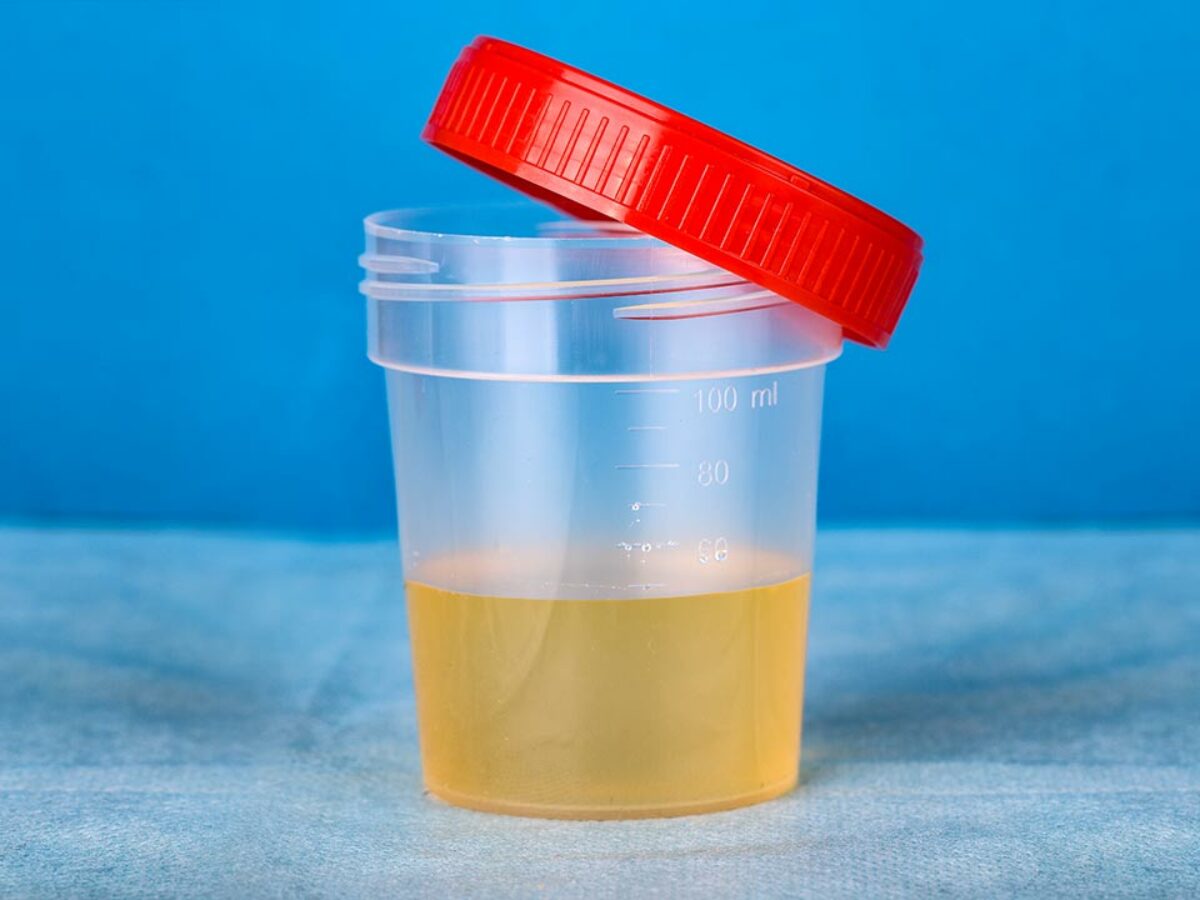 Mengflora Urine Wat Is Dat