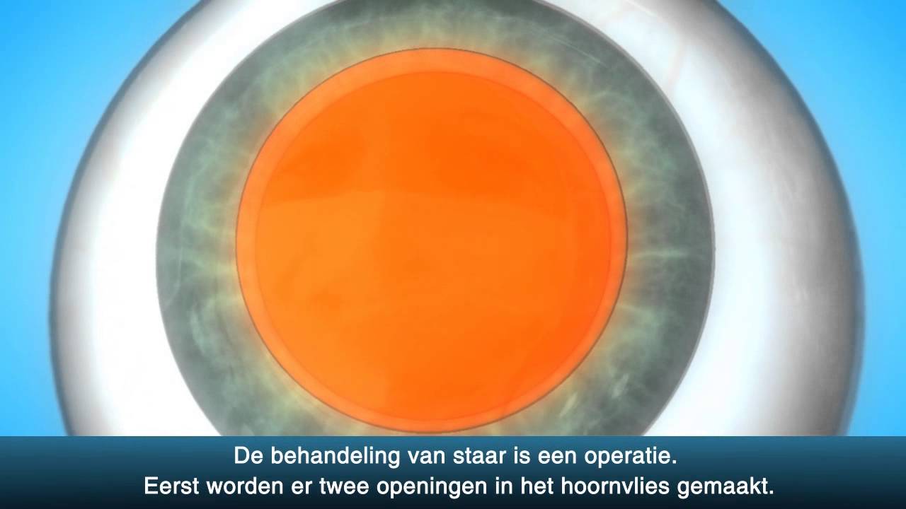 Staaroperatie (cataract) - OLVG Oogheelkunde - YouTube - Hoe Ontstaat Eiwit In Oog