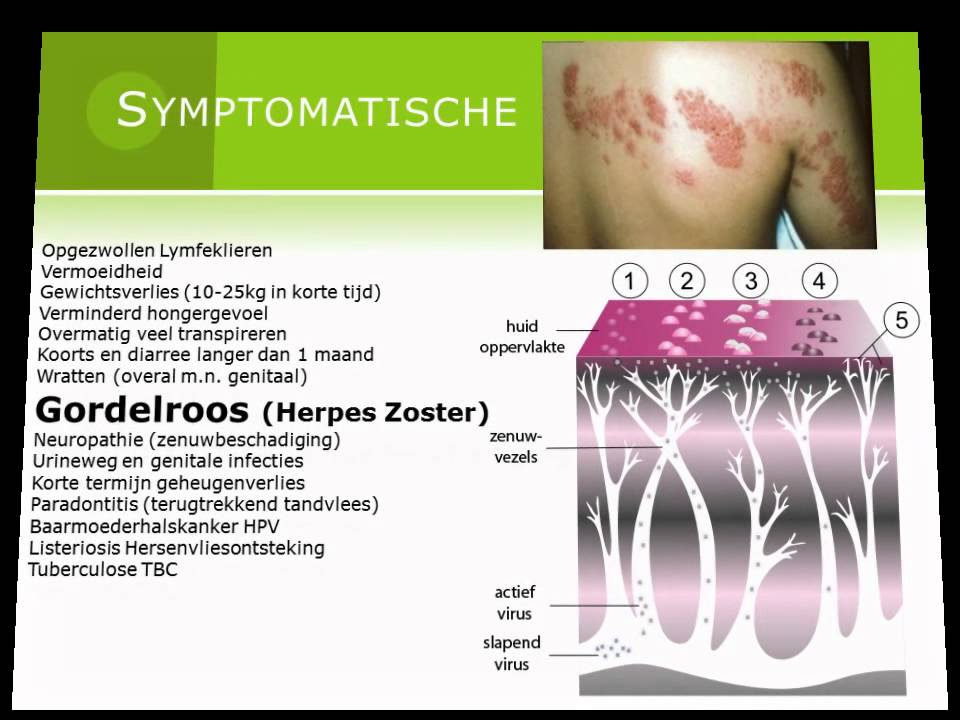 Wat Zijn De Symptomen Van Hiv