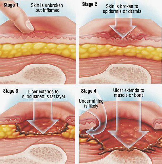 Stages of decubitus ulcer (bed or pressure sores) - MEDizzy - Decubitus Graad 5 En 6