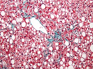 Steatosis - Libre Pathology - Steatosis Hepatis Met Focale Non-steatose