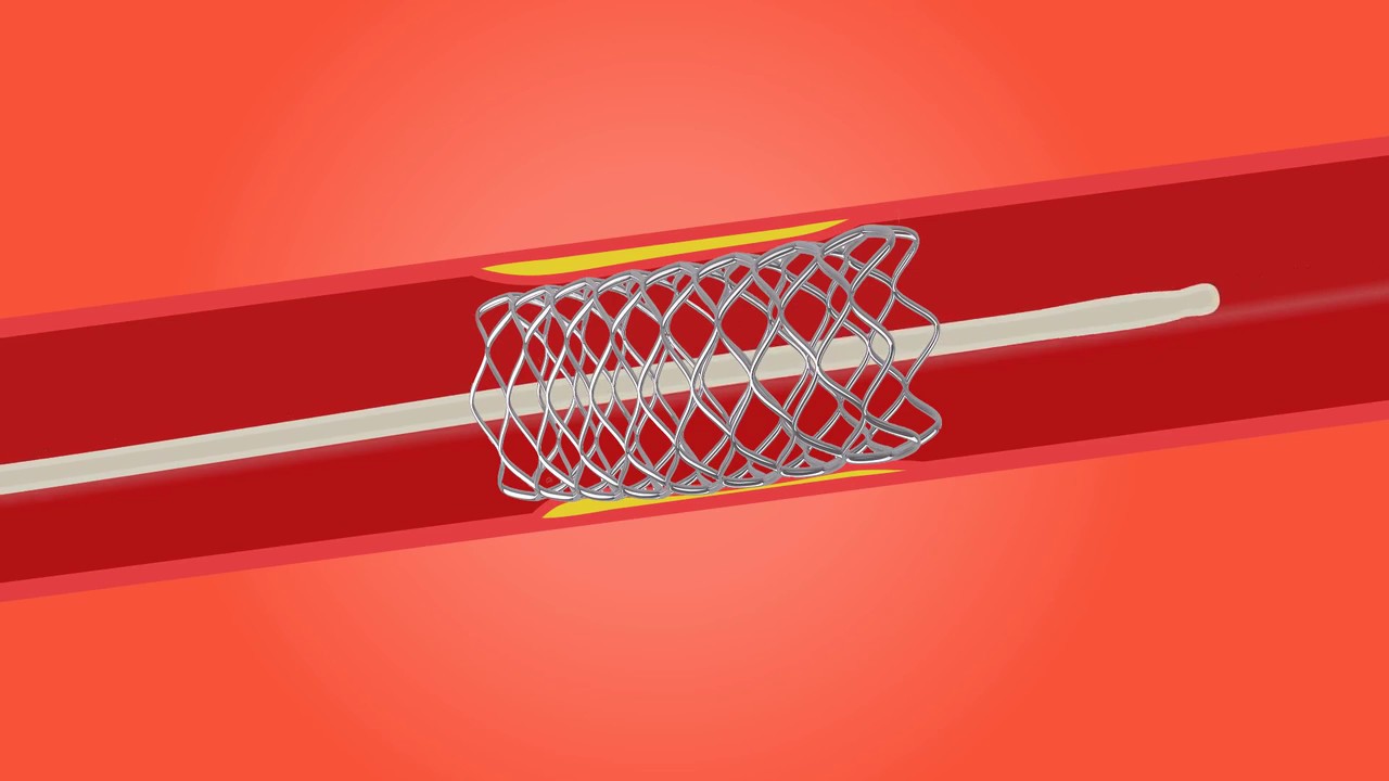 Stent procedure - YouTube - Wat Is Een Stent Hart