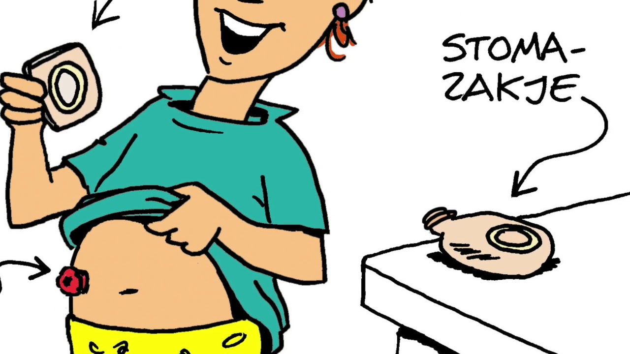 Wanneer Krijg Je Een Stoma