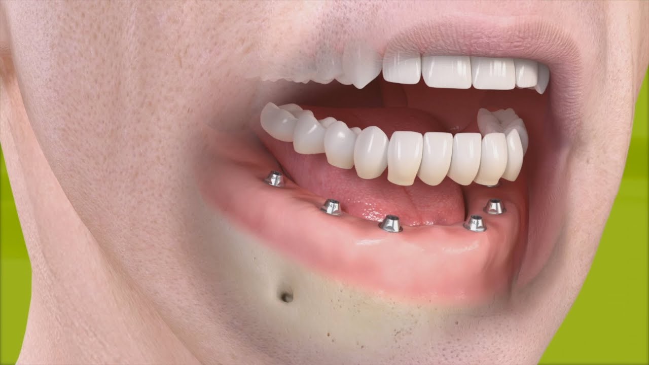 Straumann - Vaste gebitsprothese op zes implantaten - YouTube - Bovenkaak Verbreden Voor En Na
