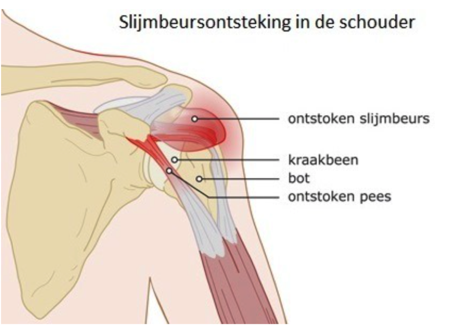 Subdeltoid Bursitis - Vocht In Nek En Schouder
