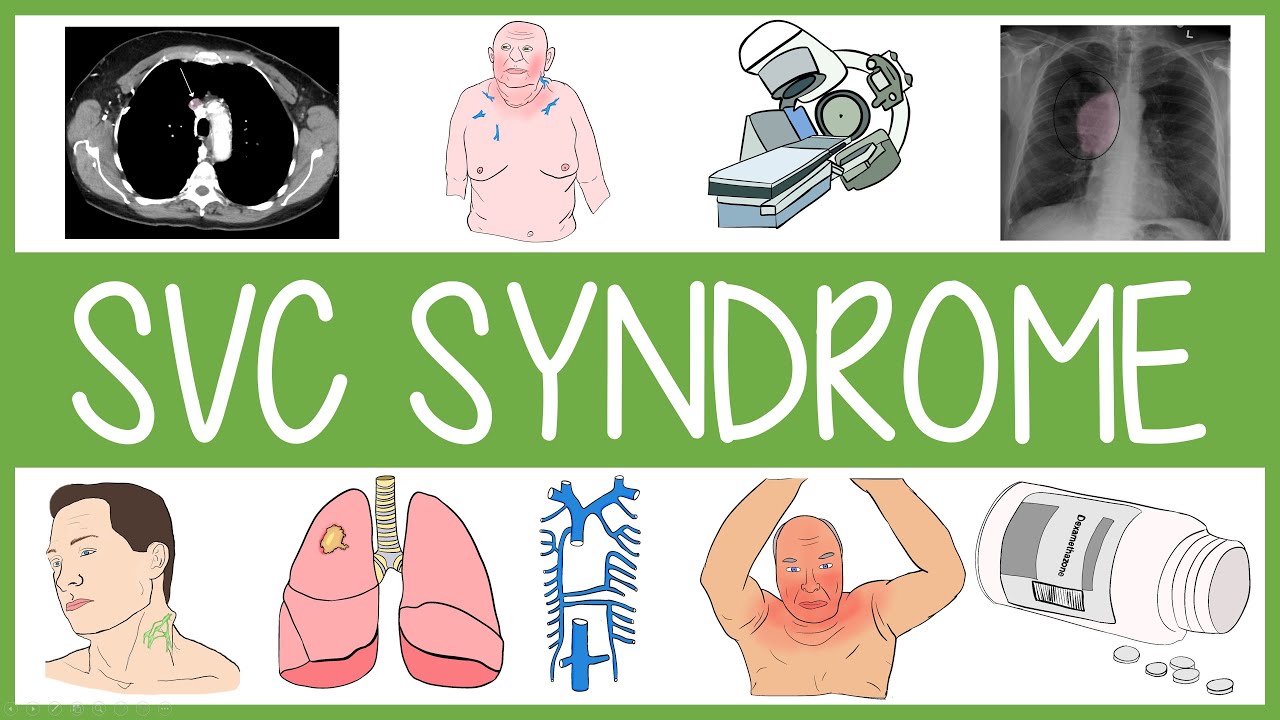 Superior Vena Cava Syndrome in 3 Minutes - YouTube - Vena Cava Superior Syndroom Symptomen