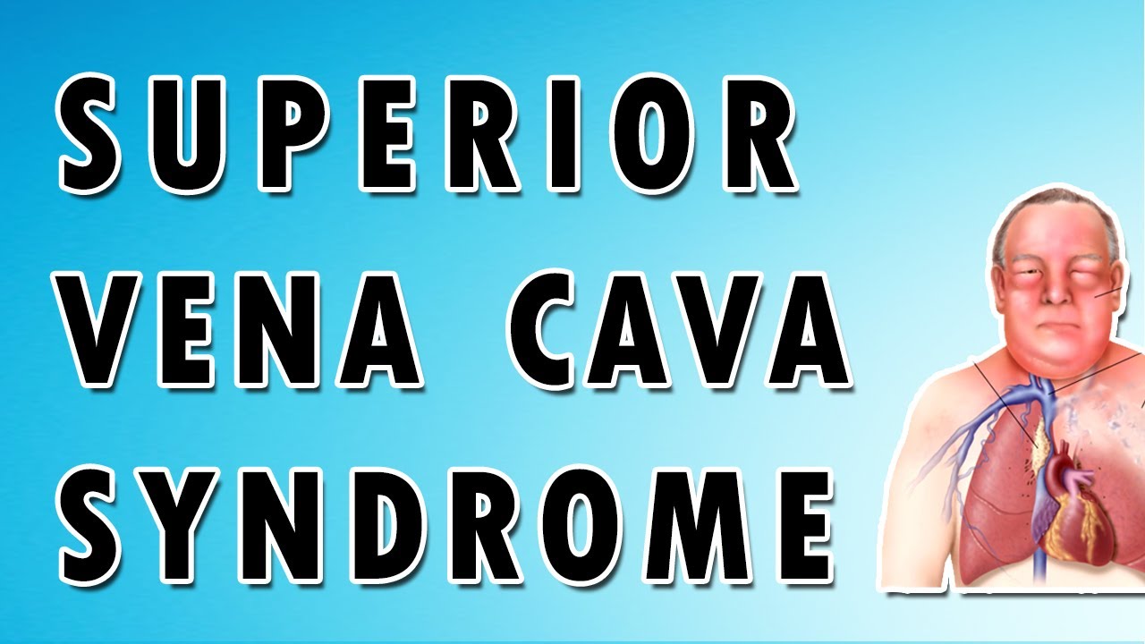 Superior Vena Cava Syndrome - YouTube - Vena Cava Superior Syndroom Symptomen
