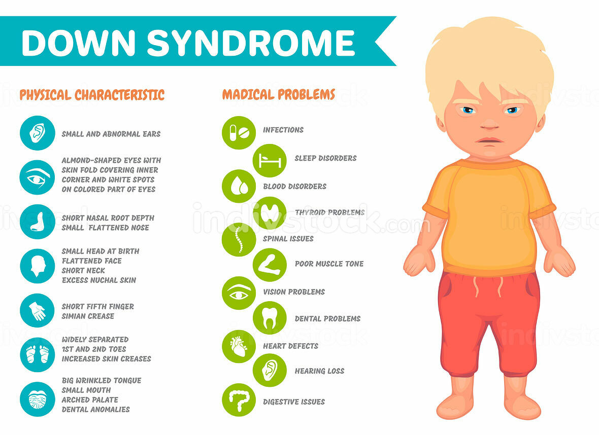 Symptoms of down syndrome poster. Illustration with little boy image - Kinderen Met Syndroom Van Down