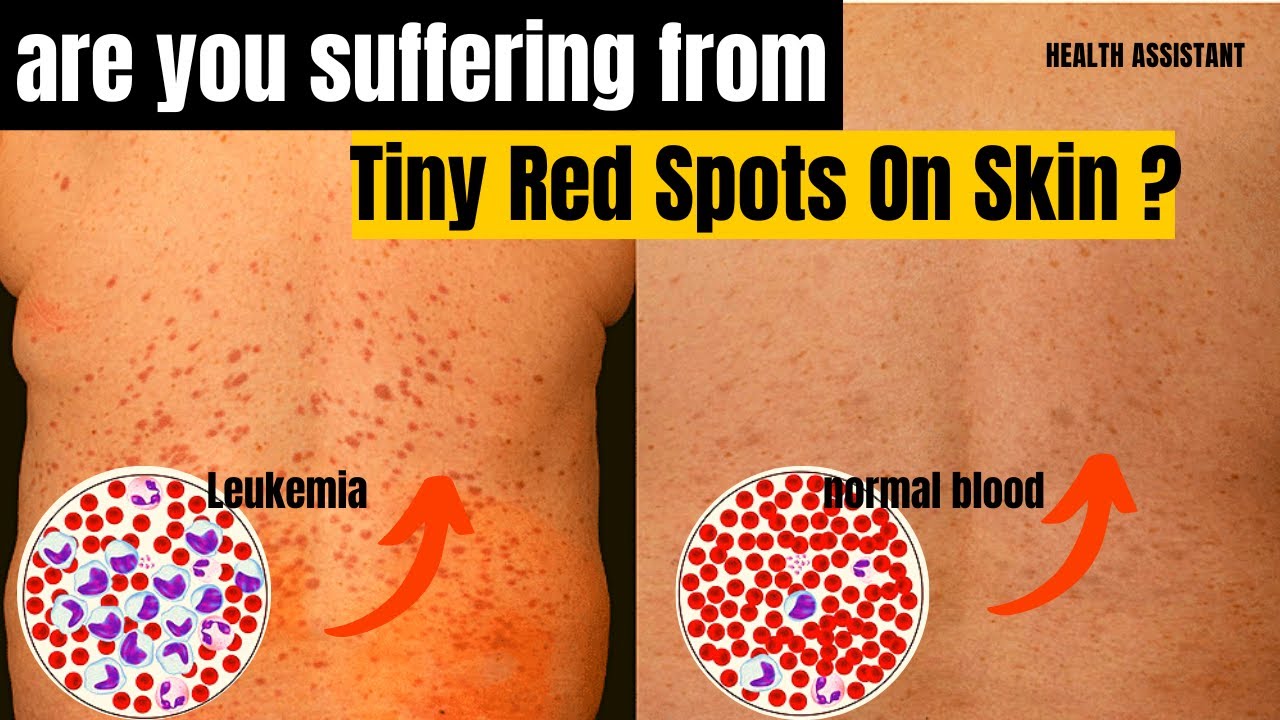 Symptoms Of Leukemia | Leukemia Tiny Red Spots On Skin | Chronic - Symptomen Leukemie Kind 4 Jaar