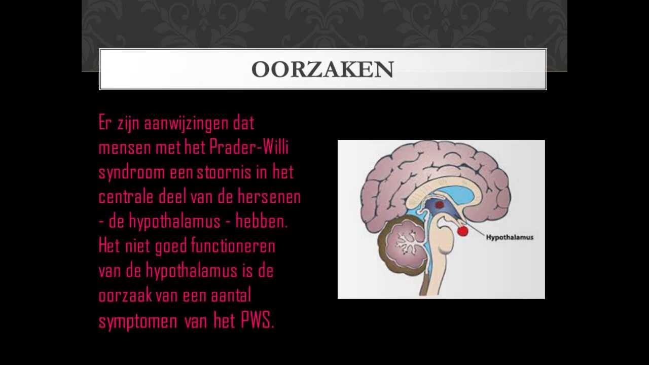 Prader Willi Syndroom Uiterlijke Kenmerken