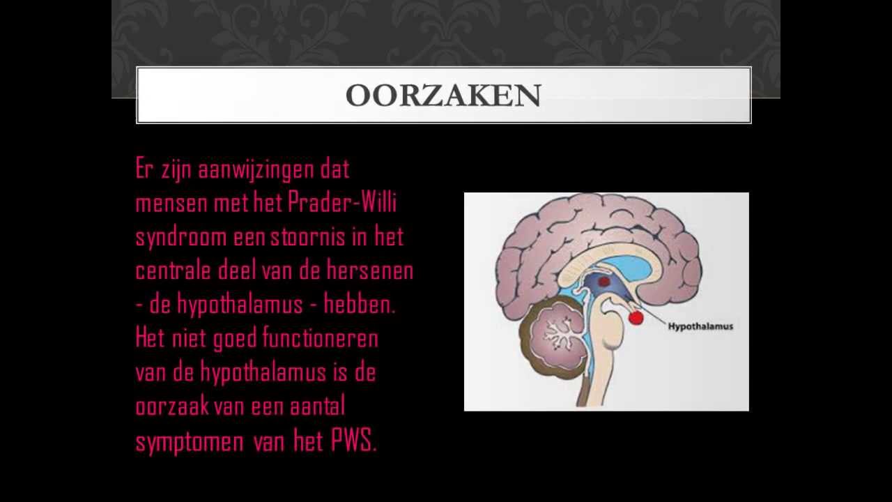 Syndroom Van Prader Willi Kenmerken
