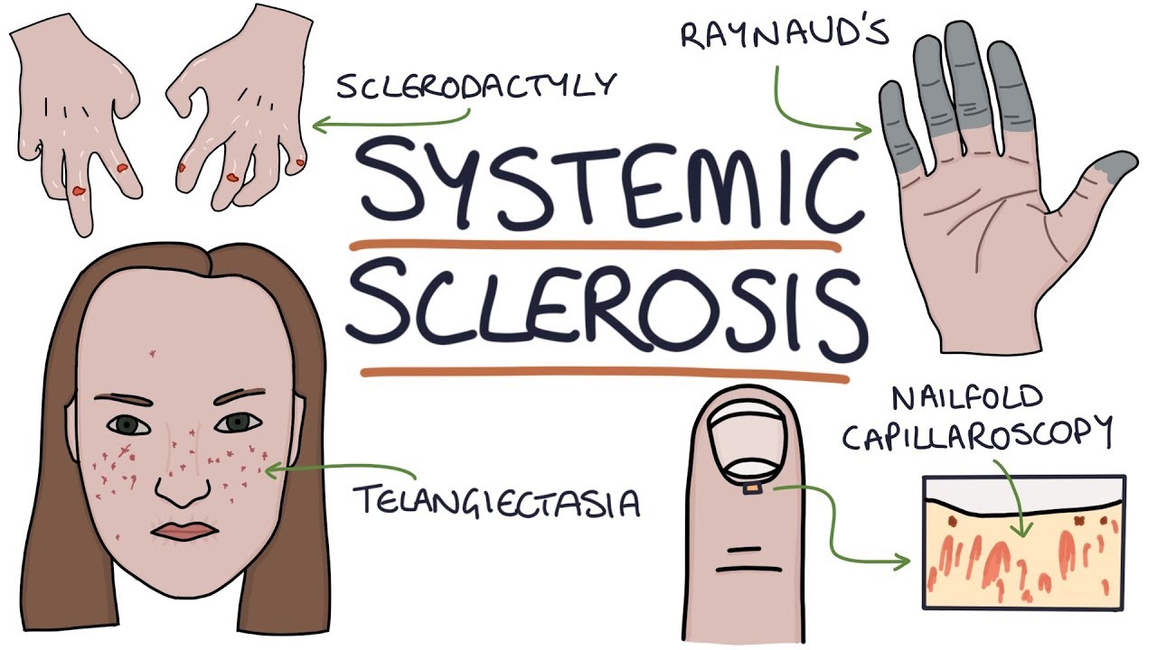 Wat Zijn De Belangrijkste Symptomen Van Systemische Sclerose