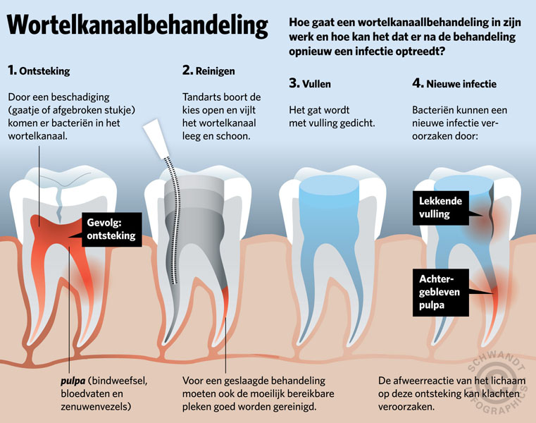 Tandartspraktijk Elahi – Wortelkanaalbehandeling - Fistel Op Tandvlees Na Wortelkanaalbehandeling