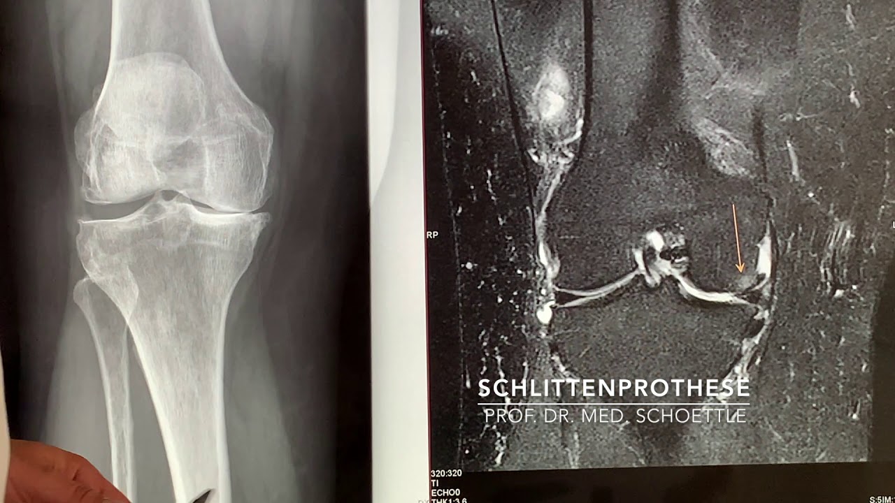 Teilprothese am Knie - Schlittenprothese - Prof. Dr. med. Philip - Gezwollen Knie Vocht In Knie