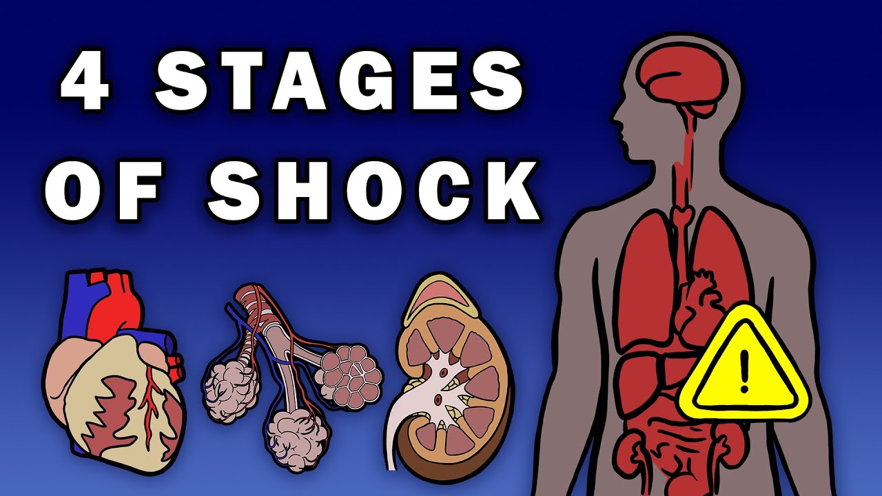 THE 4 STAGES OF SHOCK - YouTube - Wat Is Een Verschijnsel Van Een Shock