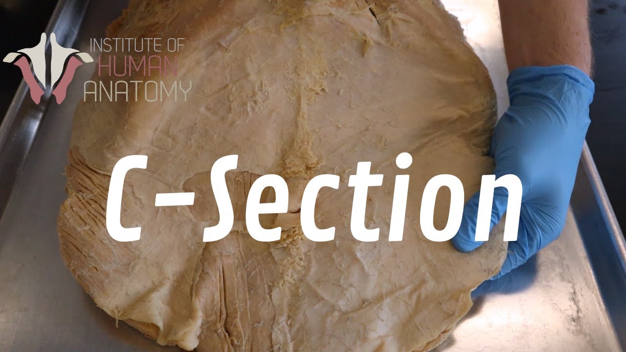 Wat Is Een C Section