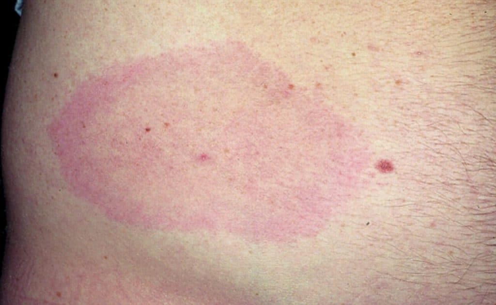 The characteristic bullseye rash for Lyme disease | Innatoss - Gebeten Door Insect Rode Vlek