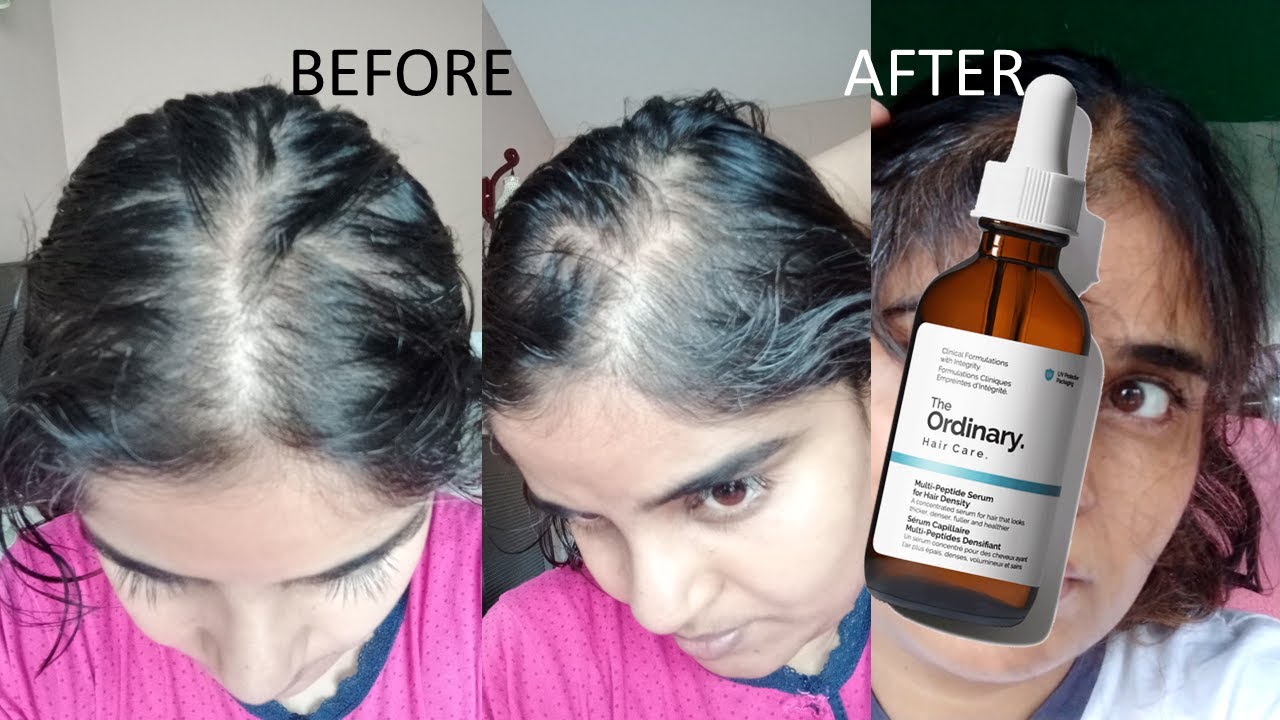 The Ordinary Hair Serum Review on Sale | cityofclovis.org - Welke Ordinary Serum Past Bij Mij