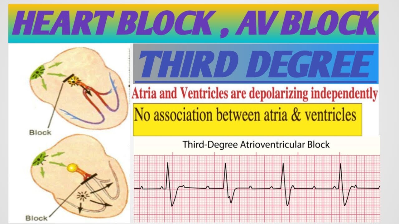 THIRD DEGREE HEART BLOCK*AV BLOCK*ATRIOVENTRICULAR BLOCK*أنسداد الدفيرة - 3e Graads Av Blok Ecg