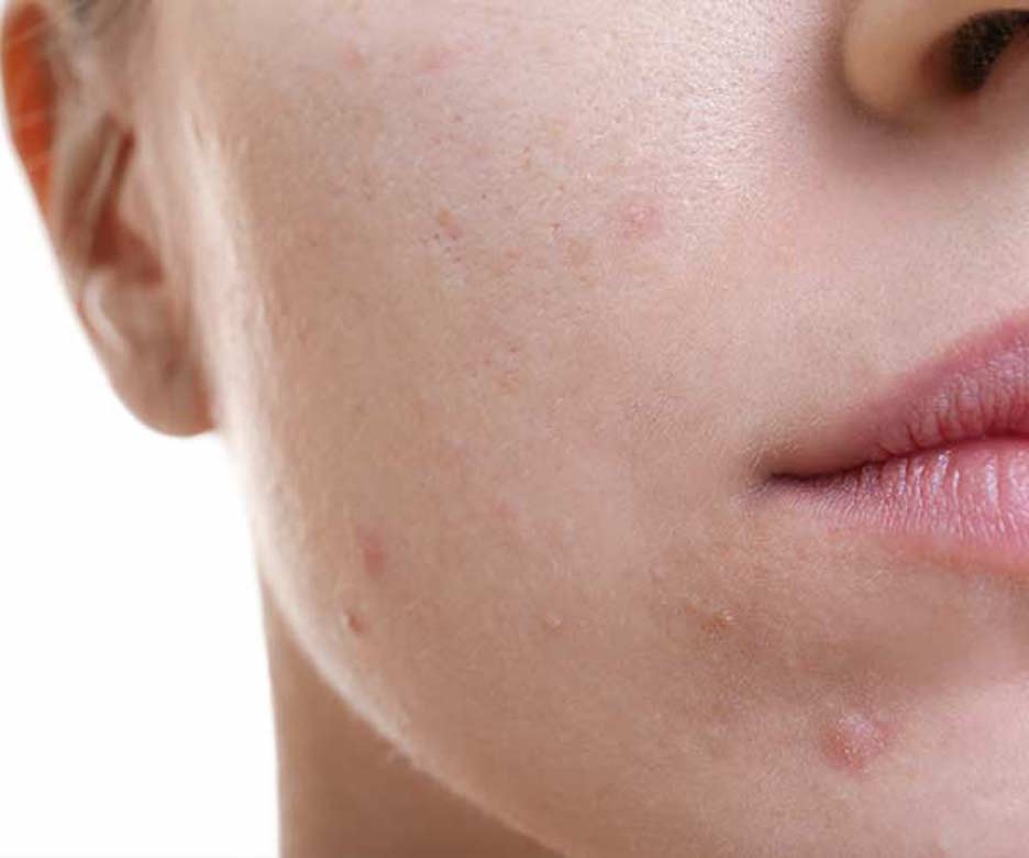 This Is The Worst Thing To Put On A Zit, According To A Dermatologist - Zit Er Veel Zout In Ijs