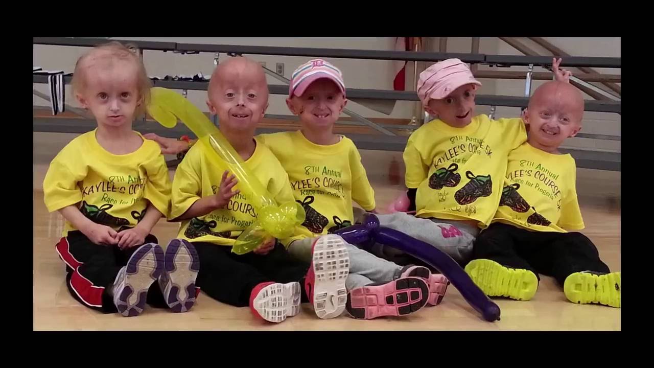 This is Who We Are Meet Children with Progeria - YouTube - Hoe Oud Worden Mensen Met Progeria