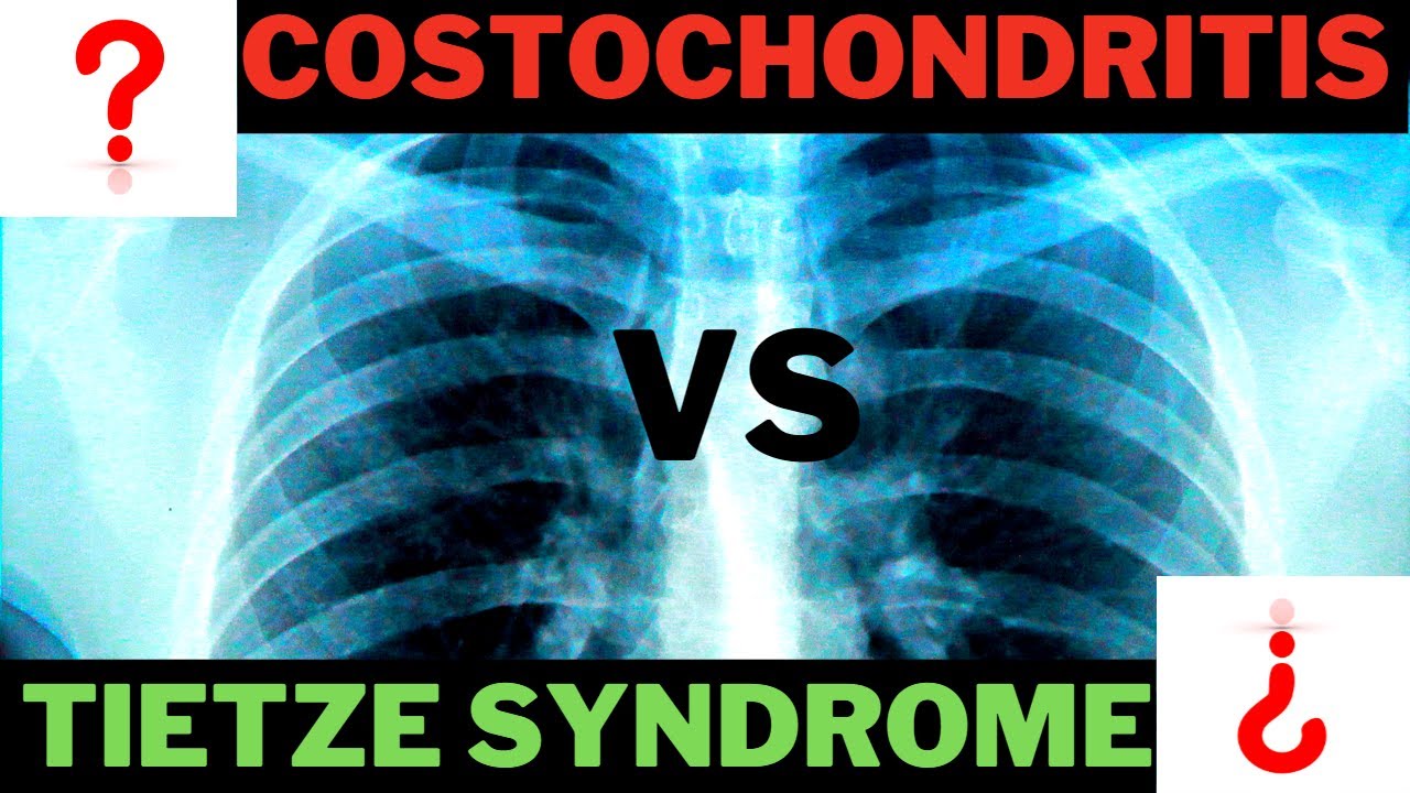 Tietze Syndrome OR Costochondritis? - YouTube - Syndroom Van Tietze 's Nachts
