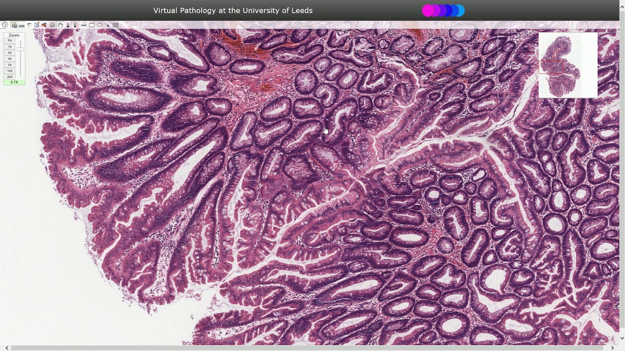 Traditional Serrated Adenoma - Histopathology - YouTube - Sessiel Serrated Laesie Zonder Dysplasie