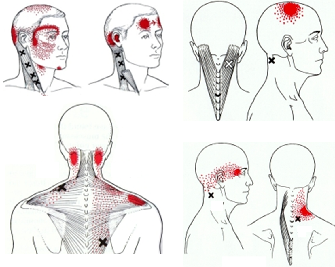 #Triggerpoints #hoofdpijn #nekpijn Hemiplegic Migraine, Ayurveda Yoga - Druk Op Oog En Hoofdpijn